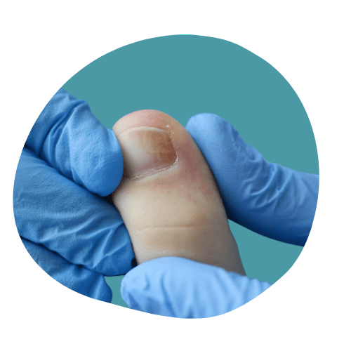 Ingrown toenail surgery sydney image